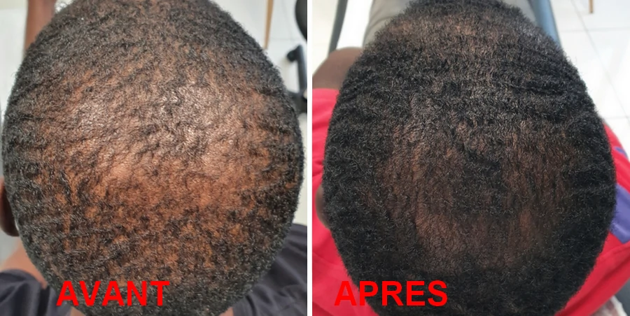 Traitement esthétique Cheveux Traitement capillaire Guadeloupe